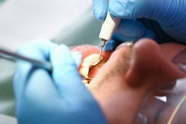 Best Emergency Dental Care for Broken or Chipped Teeth in Severance, CO